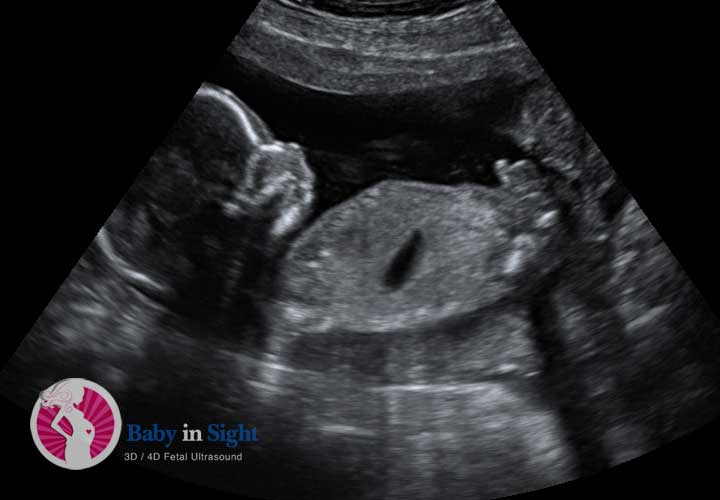 2D Obstetric Ultrasonography Image Example