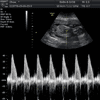 2D Fetal Heartbeat Cell Phone Recording With Printed 2D Graphic Read Out