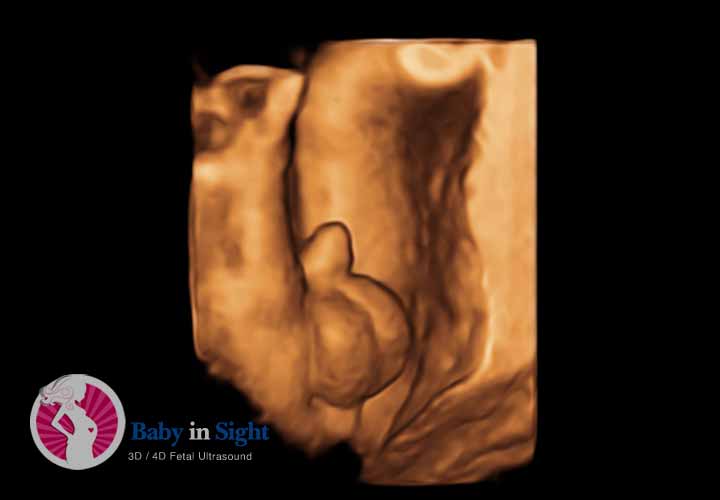 Gender Determination Ultrasound Image Example