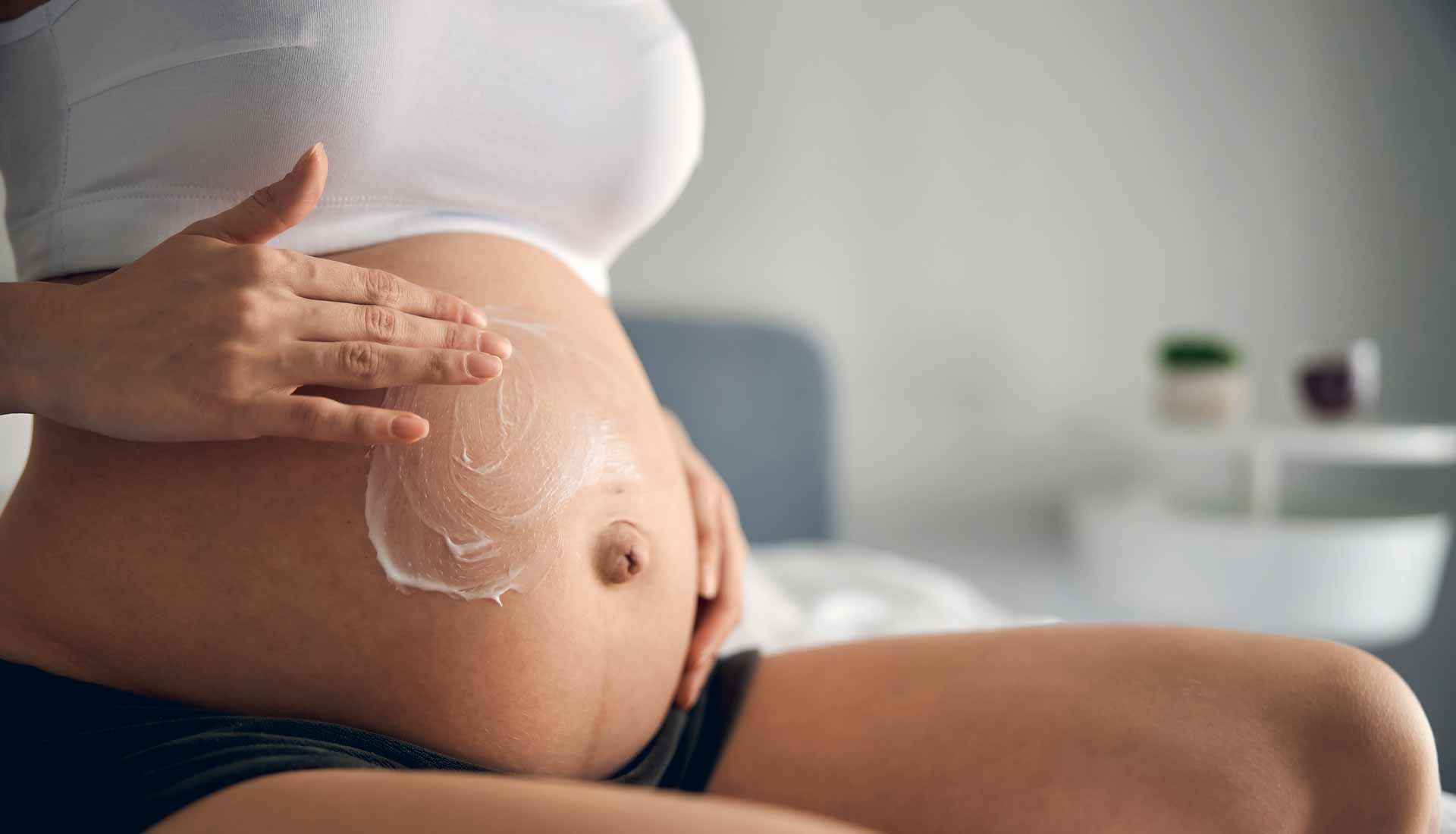 How can I treat stretch marks during pregnancy?
